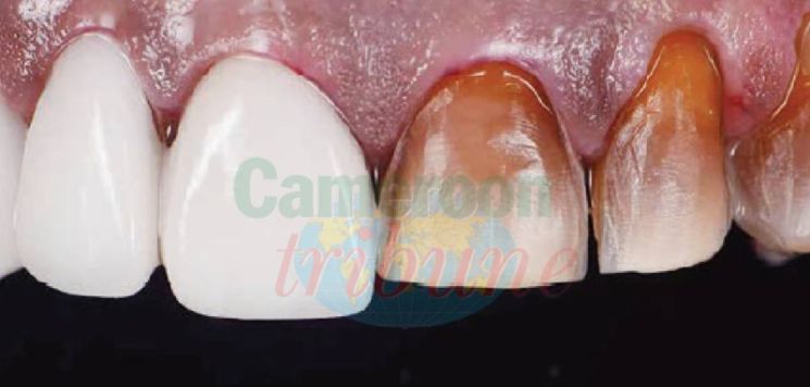 Correction et remplacement: L’option des facettes et des couronnes