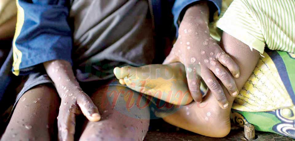 Monkey Pox : Out Break Reported In SW