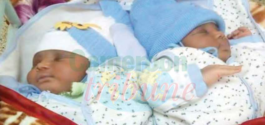 Yaounde Paediatric Hospital  : Siamese Twins Under Examination