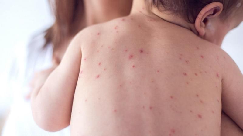 Measles:Global Alarm Bells Over Spikes In Cases