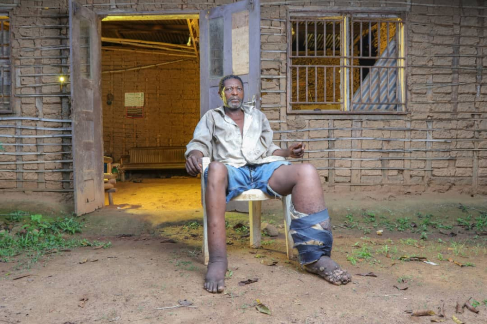 Achieving health equity to end the neglect of poverty-related diseases (Photo credit Helen Keller International Cameroon). Achieving health equity to end the neglect of poverty-related diseases (Photo credit Helen Keller International Cameroon).